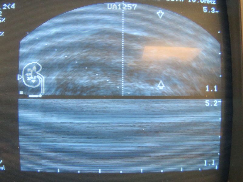 B-K Medical REF Type 8808 5-10MHz MFI transducer Falcon 2101 Ultrasound TESTED!